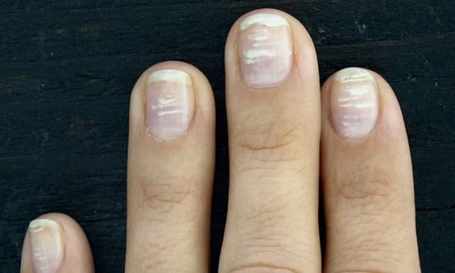 Co oznaczają białe plamki na paznokciach? Poznaj przyczyny i skutki